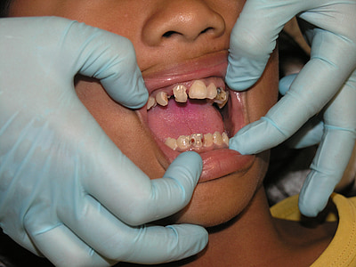 zepsute zęby, ból zęba, Leczenie stomatologiczne