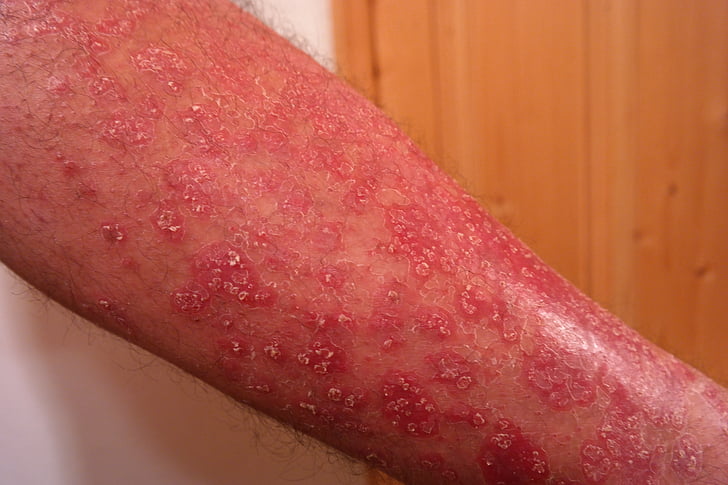 Psoriáza, heutkrankheit, červená, šupinatá, koža, zápalové kožné ochorenie, dermatóza
