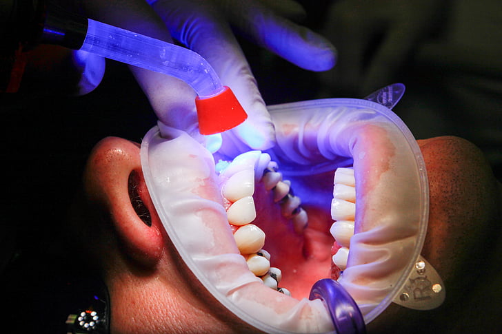 dentista, faceta, llum UV, curat, dents, boca, tractament