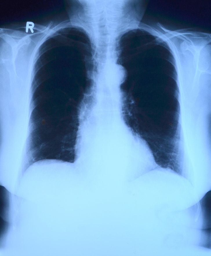 imagen de rayos x, rayos x, Tórax, radiografía de pulmón, médicos, examen médico, salud y medicina