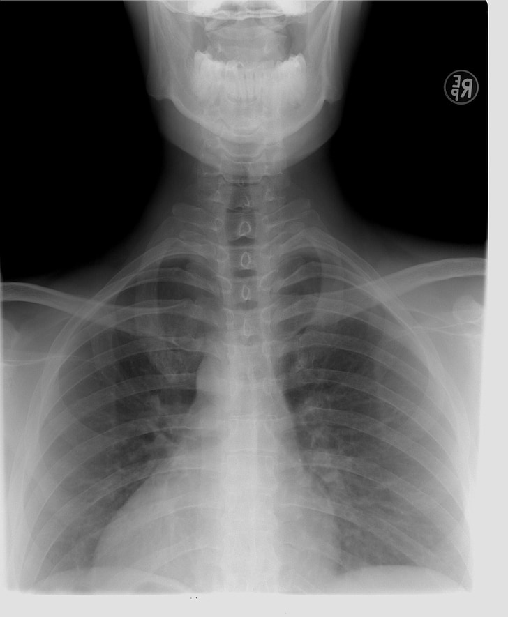 Rayos, espina dorsal torácica, diagnóstico