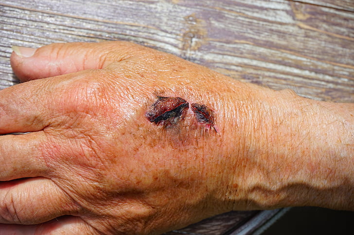 käsi, vahingon, ihon hankausta, Gall, verinen, onnettomuus, haavoittaminen
