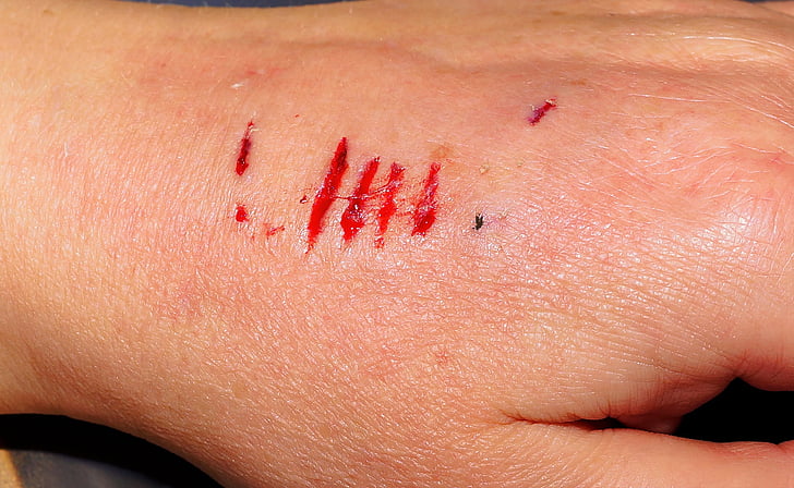 mà, lesió, mossegada, mossegada de gos, dolorosa, sang, ferides