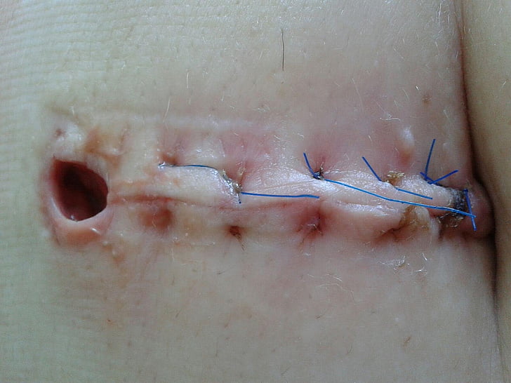 ferida, operació, costura, cicatriu, fil, pacient, secció