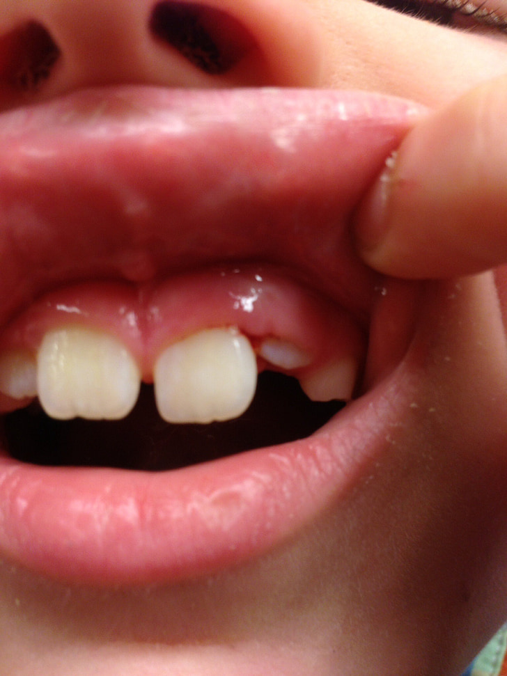 zob, usta, zobozdravstvene