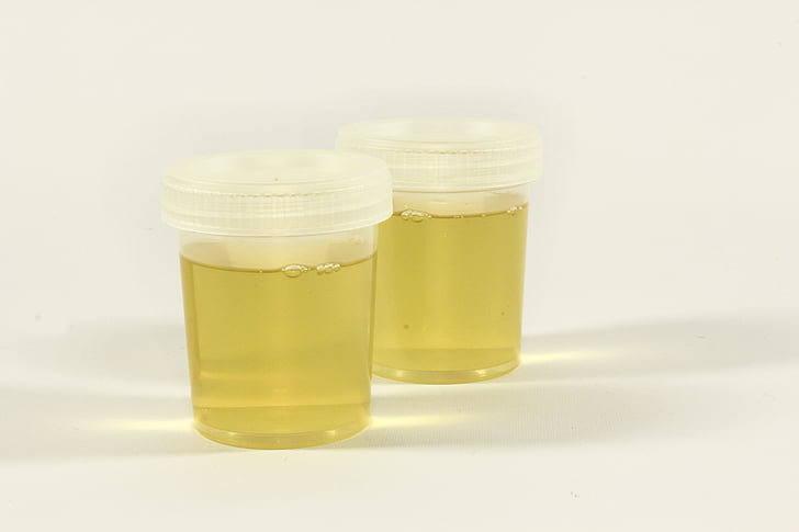 testen, urin container, urin, betennelse, analyse, medisinsk, laboratoriet