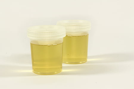 de test, urine container, urine, ontsteking, analyse, medische, laboratorium