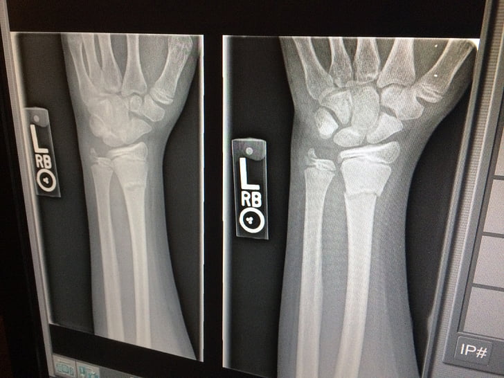x-ray, medische, gebroken, arm, arts, x ray, geneeskunde