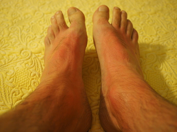 päikesepõletus, jalad, naha, punane, Kõrvetatud, loputada, allergia
