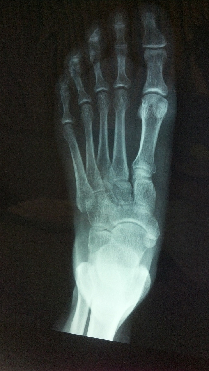 x ray, noha, kost