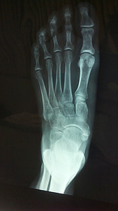x ray, เท้า, กระดูก