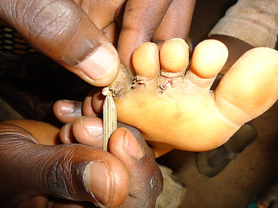 Châu Phi, đói nghèo, bệnh, bàn chân, nỗi đau, bọ chét, bẩn