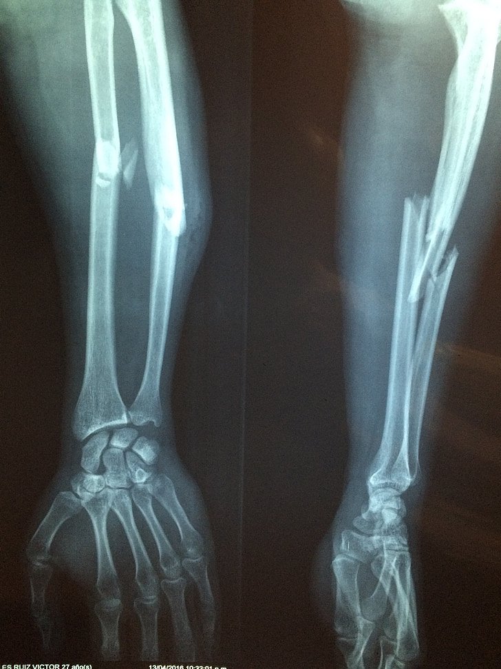 fracture bone, xray, skeleton, diagnosis, broken, health, hospital