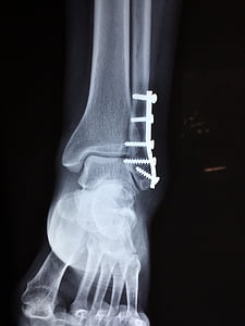 ankle, fracture, foot, medical, accident, trauma, health
