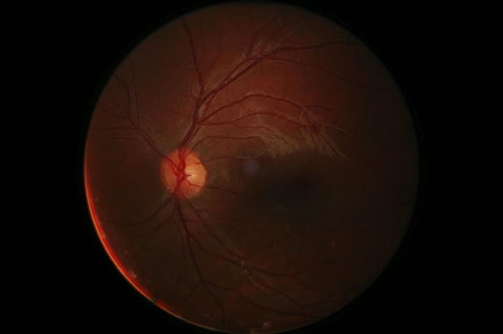 fotografia retinal digital, globo ocular, digital, retinal, córnea, olho, humana