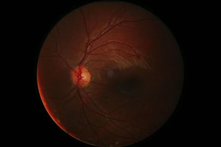 цифрова фотография на ретината, очната ябълка, цифров, ретината, роговицата, око, човешки