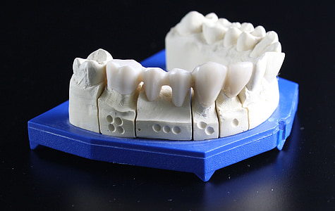 sostituzione del dente, dente, odontotecnico
