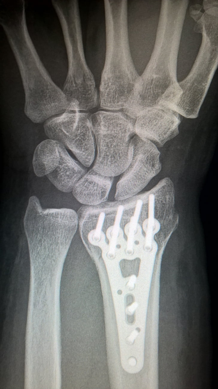 bras cassé, fixation de la plaque, plaque de titane, fracture du radius, poignet, chirurgie, chirurgie traumatologique