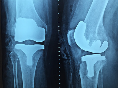 médico, Ortopedia, raio-x, joelho