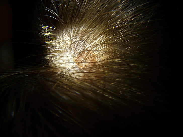 scalp, mole, head, hair, spot
